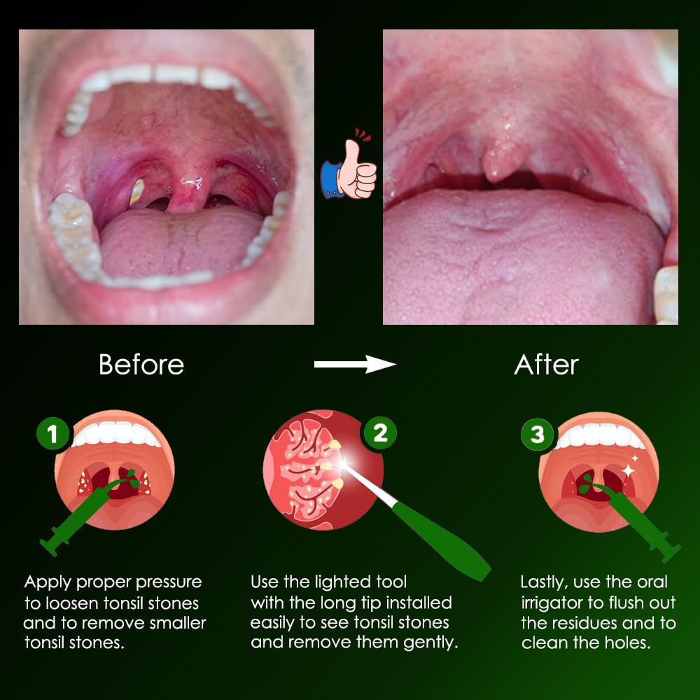 Effective Ways to Get Rid of Tonsil Stones at Home in 2025 – Discover Proven Methods!