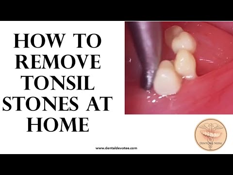 How to get rid of tonsil stones at home